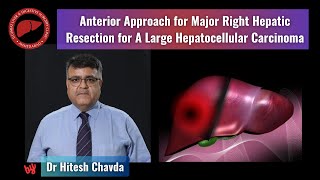 The anterior approach for right hepatectomy for a large hepatocellular carcinoma  Dr Hitesh Chavda [upl. by Aicilef71]