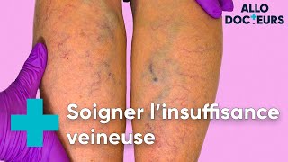 Jambes lourdes varices il existe des solutions  Allo Docteurs [upl. by Laenaj]