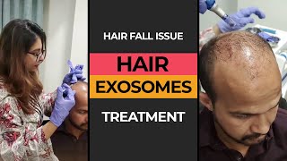 Exosomes Treatment for Hair Fall Issue  HASH CLINICS [upl. by Nahtanha]