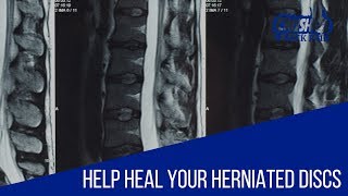 How a Herniated Disc Will Heal and How to Help it Heal Faster and Stronger [upl. by Karp522]