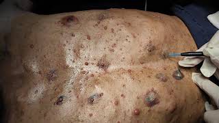 Cutaneous Neurofibroma removal by RF technique [upl. by Namas]