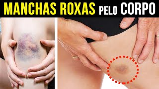 MANCHAS ROXAS no corpo com frequencia O QUE FAZER [upl. by Oab]