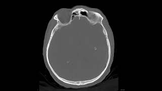 Extradural hemorrhage1 [upl. by Fogel956]