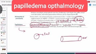 papilledema ophthalmology 20  First Aid USMLE Step 1 in UrduHindi [upl. by Aileduab]