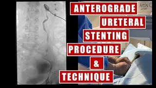 Transnephrostomy Ureteral Stent placement under fluoroscopy guidance procedure and technique [upl. by Neerahs]