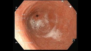 Gastric erosions Gastritis Endoscopy EsophagogastroduodenoscopyReflux esophagitisBiopsy Cancer [upl. by Velma]