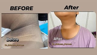 Acanthosis Nigricans Treatment Before And After ❤️👍DrSakeenaparveen [upl. by Namyaw221]