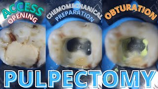 Access Opening 🟡 Chemomechanical Preparation 🟣 Obturation ⚪️ Pulpectomy [upl. by Simonetta]