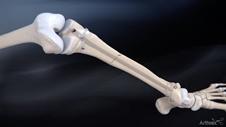 Tibial Nail System—Standard Surgical Technique [upl. by Watt167]