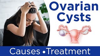 ❇️ What are Ovarian Cysts  💹Ovarian Cysts Symptoms Causes And Treatment in Hindi [upl. by Pirri459]