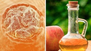 How to Remove Warts at Home Using Apple Cider Vinegar [upl. by Sirc]