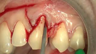 9 Multiple bilaminar technique with single vertical releasing incision in the upper jaw [upl. by Ahsahtan394]