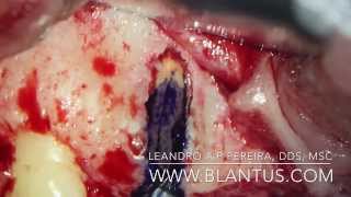 Endodontic Microsurgery [upl. by Jona223]