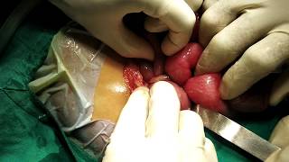 Laparatomy  Mekels Diverticulum Intestinal obstruction [upl. by Sioled]