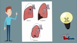 ATELECTASIA Colapso Pulmonar  HomeostasisTv [upl. by Rikahs]