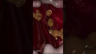 What Can Cause Stomach Ulcers Animation animation science 3danimation love biology film new [upl. by Meeharbi]