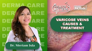 Varicose Veins Causes amp Treatment  Health Matters  October 14 2024 [upl. by Smeaj]