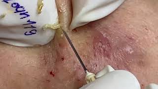 BEST BLACKHEADS EXTRACTION 119  Loan Nguyen [upl. by Enelkcaj]