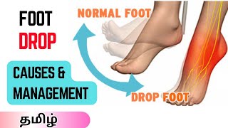 Foot drop Causes Symptoms and Management Tamil  Common Peroneal Nerve Injury [upl. by Main29]