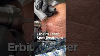 Erbium Laser Spot Treatment 💥 [upl. by Gauldin]