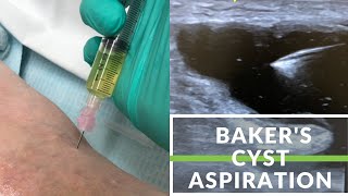 Simple Bakers Cyst Aspiration [upl. by Beshore]