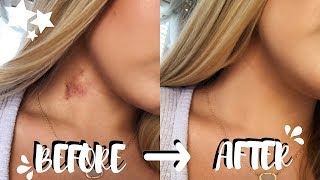 How To Get Rid Of Hickeys In Two EASY Steps no color correcting  Brooklyn Anne [upl. by Eireva]