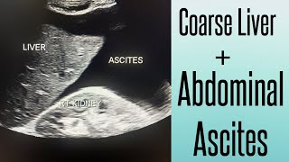 Coarse Liver amp Abdominal Ascites on Ultrasound  Chronic Liver Disease  Liver Cirrhosis [upl. by Klara]