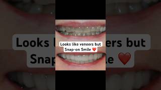 When they look like veneers but are amazing removable cosmetic appliance ❤️ [upl. by Bayer910]