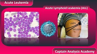 E2 Acute Lymphoblastic Leukemia ALL سرطان الدم الليمفاوى الحاد [upl. by Oletta]