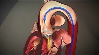 Transcatheter Aortic Valve Replacement  TAVR [upl. by Kirsten620]