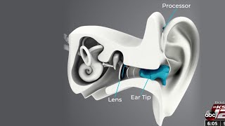 New device for hearing loss acts like a contact lens for the ear [upl. by Airdnazxela]