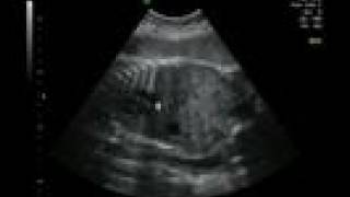 Life in the Womb IV 33 weeks ultrasound [upl. by Tneicniv942]