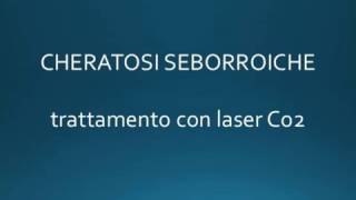 Trattamento con Laser Co2 Cheratosi seborroiche  Dr Andrea Platamone [upl. by Martreb]