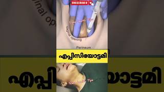 പ്രസവസമയത്ത് episiotomy ചെയ്യുന്നത്pregnancy education malayalam [upl. by Curkell290]