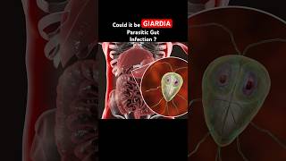 Giardia Infection is often mistaken for IBS Symptoms guthealth shorts youtubeshorts [upl. by Cowey789]