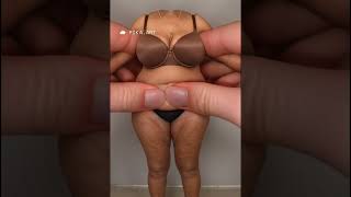 Tummy Tuck Before and After [upl. by Harriman]