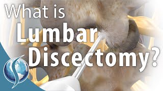 Lumbar Discectomy [upl. by Nodlew]