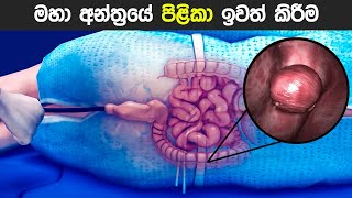 මහා බඩවැලේ පිළිකා 😨 Removal of polyps from large intestine  Colon polypectomy in sinhala [upl. by Nonez638]