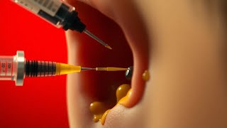 AnikaENT  Alternative earwax removal treatments Ep122 [upl. by Githens]