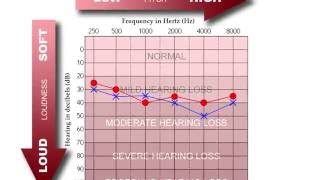 How to Read an Audiogram [upl. by Eulalie]