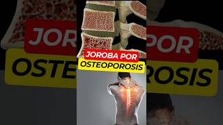 Síntomas Ocultos de OSTEOPOROSIS 😱 [upl. by Naro]