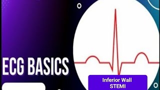 ECG Basics  Inferior wall STEMI [upl. by Trautman]