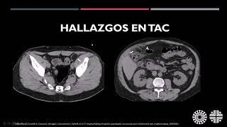 Caso Clínico 82 Apendagitis [upl. by Etyam465]