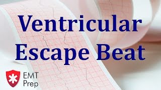 Ventricular Escape Beat ECG  EMTprepcom [upl. by Cini]