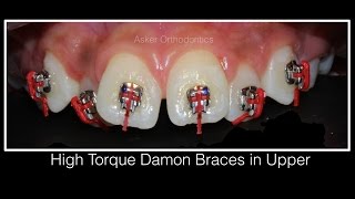 Orthodontic case presentation of Class II division 1 Damonortho education extractiondeep bite [upl. by Leva]