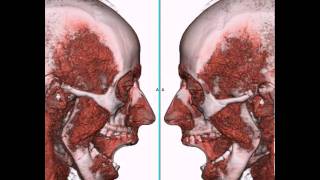 Articulación Temporo Mandibular ATM a través de TC 4D [upl. by Lennod]