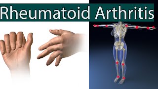 Rheumatoid Arthritis  Symptoms Causes Risk factors and Treatment [upl. by Dnallor]