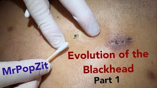 Evolution of the blackhead part 1 The rare trident blackhead Triple barrel extraction [upl. by Raleigh]