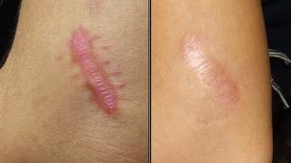 DermTV  How to Treat Raised Scars DermTVcom Epi 254 [upl. by Loziram]