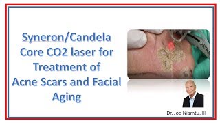 The SyneronCandela Core CO2 Laser Treatment for Acne Scars and Facial Aging [upl. by Iruy336]